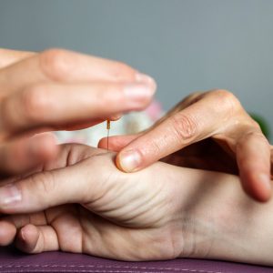 hand acupuncture